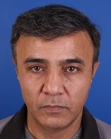 After Hair Transplant &nbsp;Front